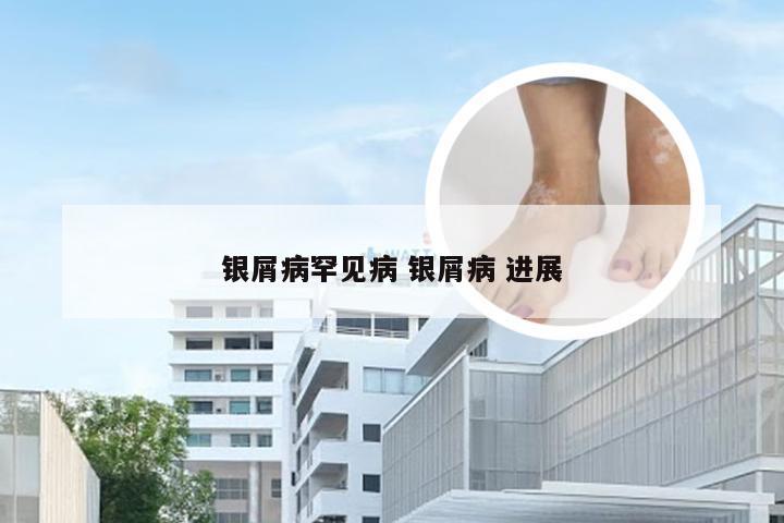 银屑病罕见病 银屑病 进展