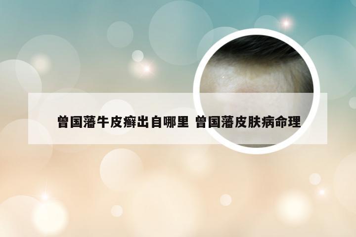 曾国藩牛皮癣出自哪里 曾国藩皮肤病命理