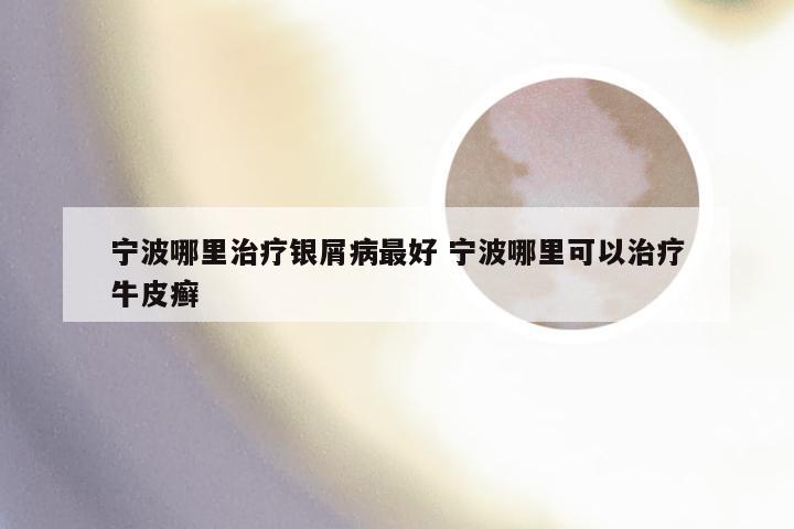 宁波哪里治疗银屑病最好 宁波哪里可以治疗牛皮癣