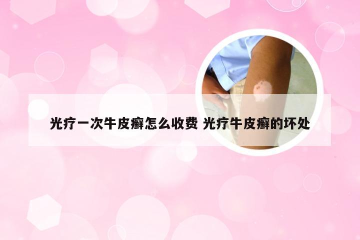 光疗一次牛皮癣怎么收费 光疗牛皮癣的坏处