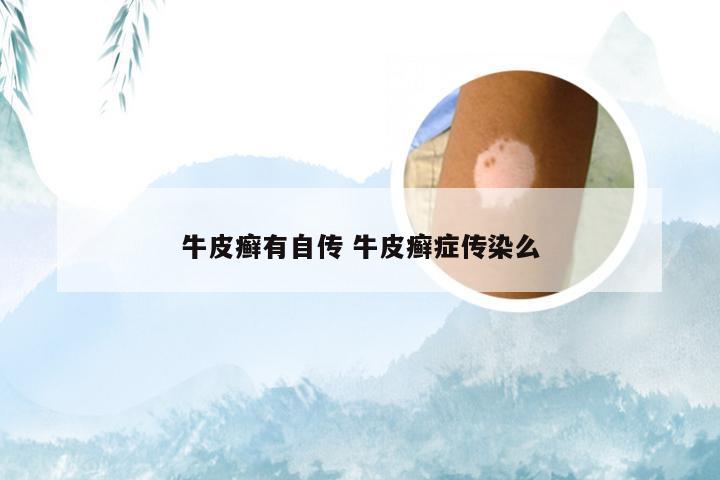 牛皮癣有自传 牛皮癣症传染么