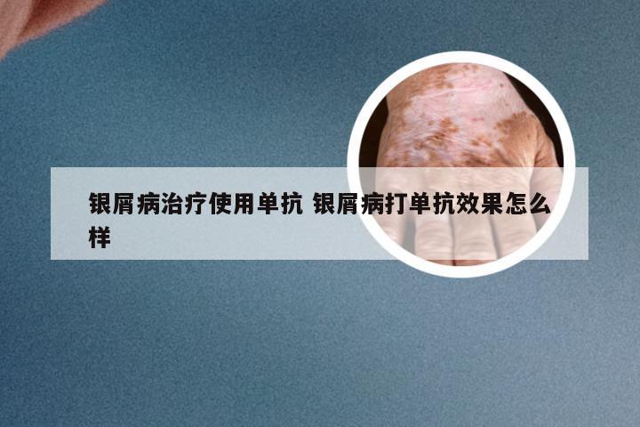 银屑病治疗使用单抗 银屑病打单抗效果怎么样