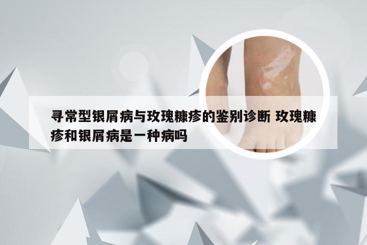 寻常型银屑病与玫瑰糠疹的鉴别诊断 玫瑰糠疹和银屑病是一种病吗