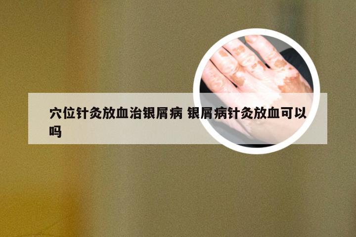 穴位针灸放血治银屑病 银屑病针灸放血可以吗