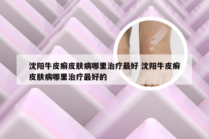 沈阳牛皮癣皮肤病哪里治疗最好 沈阳牛皮癣皮肤病哪里治疗最好的