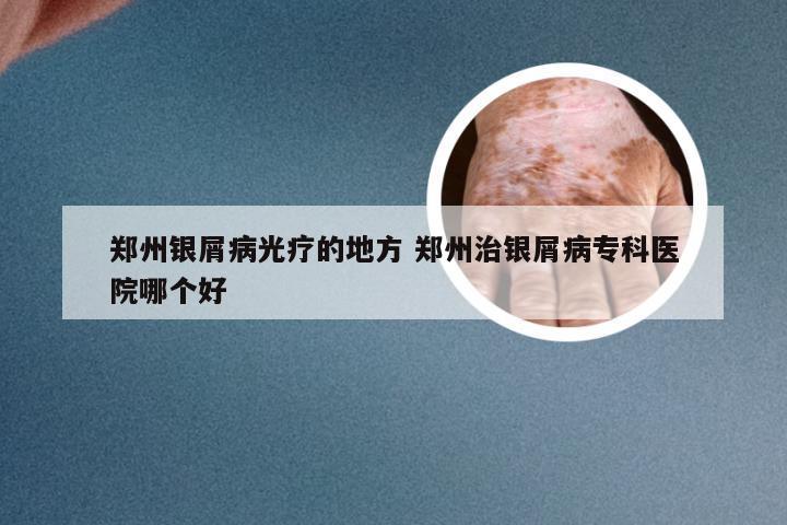 郑州银屑病光疗的地方 郑州治银屑病专科医院哪个好