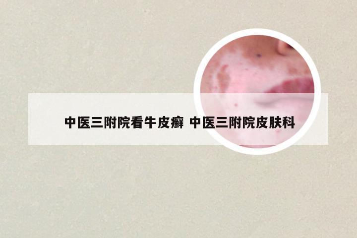 中医三附院看牛皮癣 中医三附院皮肤科