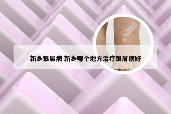 新乡银屑病 新乡哪个地方治疗银屑病好
