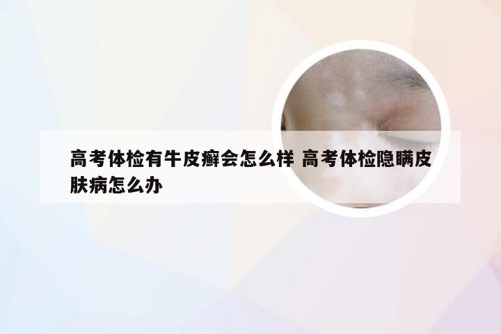 高考体检有牛皮癣会怎么样 高考体检隐瞒皮肤病怎么办