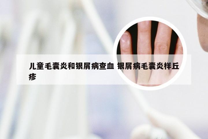 儿童毛囊炎和银屑病查血 银屑病毛囊炎样丘疹