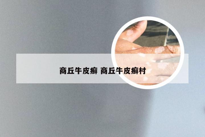 商丘牛皮癣 商丘牛皮癣村