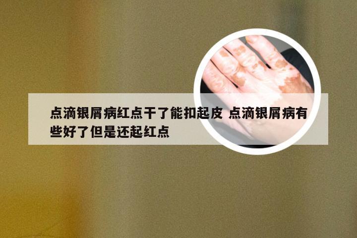 点滴银屑病红点干了能扣起皮 点滴银屑病有些好了但是还起红点