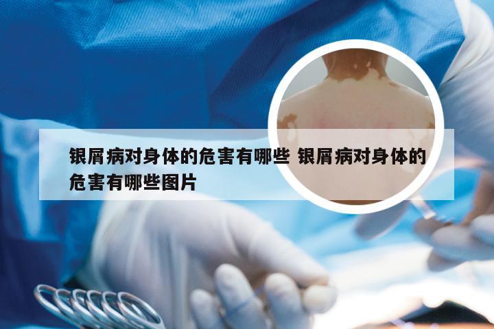 银屑病对身体的危害有哪些 银屑病对身体的危害有哪些图片