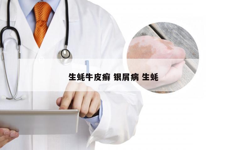生蚝牛皮癣 银屑病 生蚝