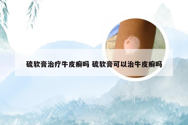 硫软膏治疗牛皮癣吗 硫软膏可以治牛皮癣吗