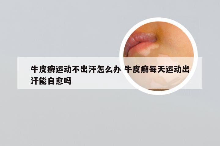 牛皮癣运动不出汗怎么办 牛皮癣每天运动出汗能自愈吗