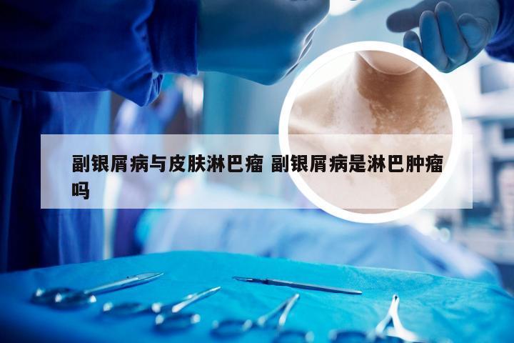副银屑病与皮肤淋巴瘤 副银屑病是淋巴肿瘤吗