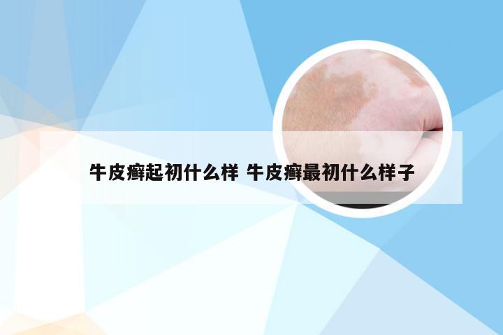 牛皮癣起初什么样 牛皮癣最初什么样子