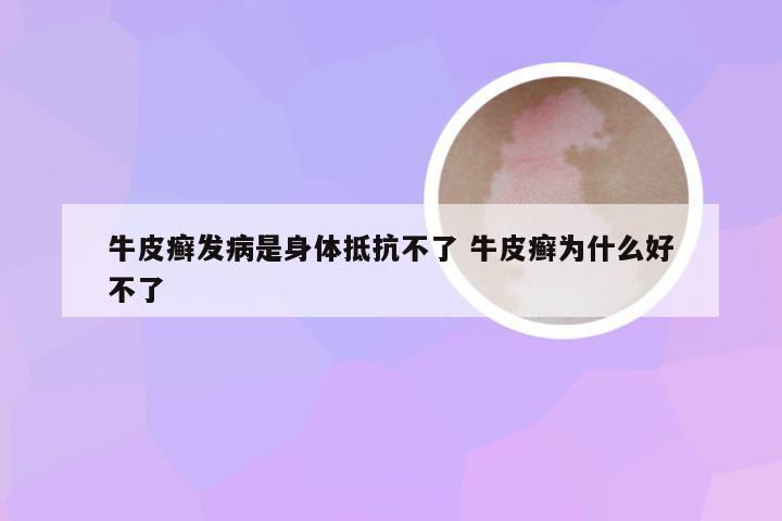 牛皮癣发病是身体抵抗不了 牛皮癣为什么好不了