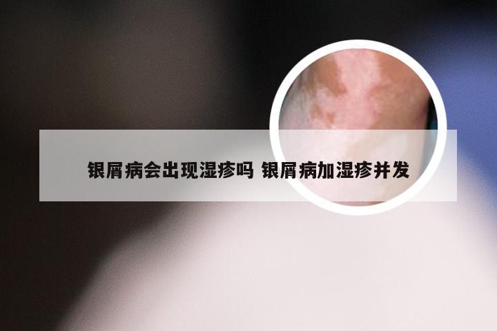 银屑病会出现湿疹吗 银屑病加湿疹并发