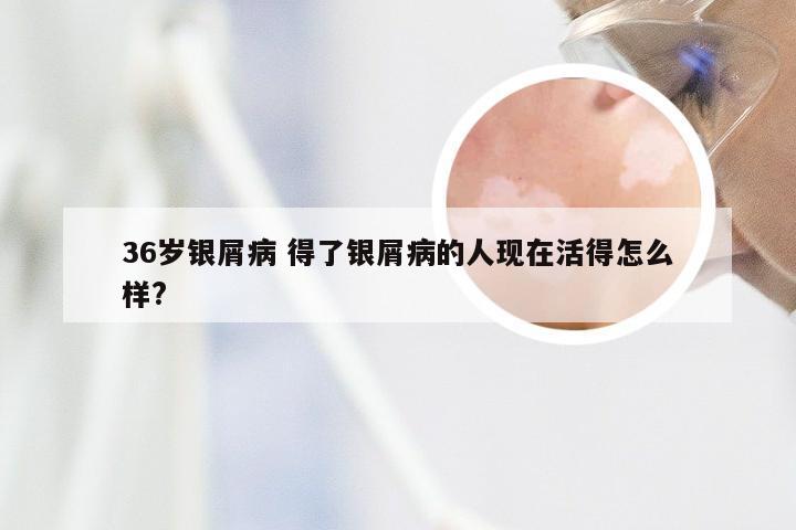36岁银屑病 得了银屑病的人现在活得怎么样?