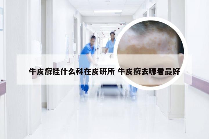 牛皮癣挂什么科在皮研所 牛皮癣去哪看最好
