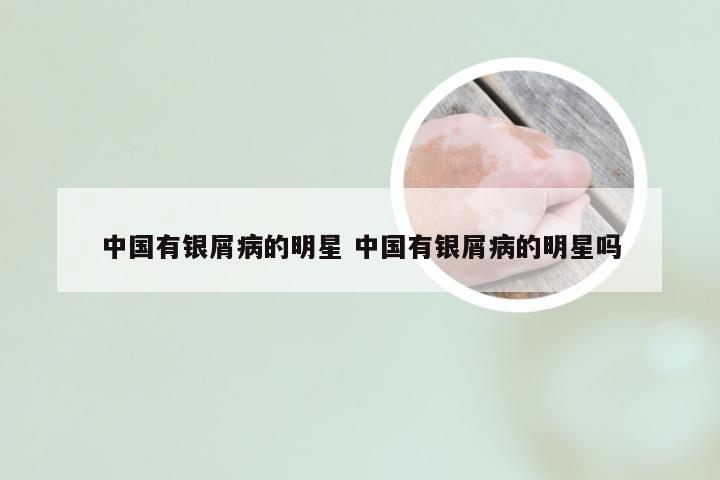 中国有银屑病的明星 中国有银屑病的明星吗