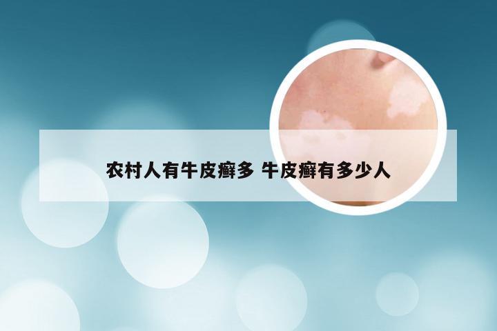 农村人有牛皮癣多 牛皮癣有多少人