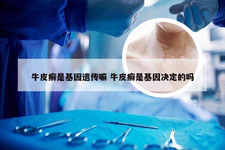 牛皮癣是基因遗传嘛 牛皮癣是基因决定的吗