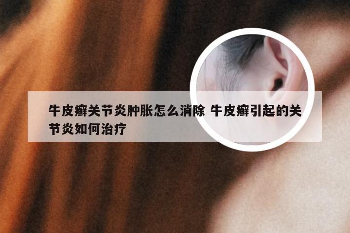 牛皮癣关节炎肿胀怎么消除 牛皮癣引起的关节炎如何治疗