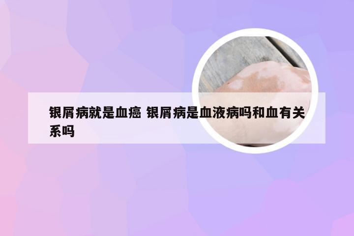 银屑病就是血癌 银屑病是血液病吗和血有关系吗