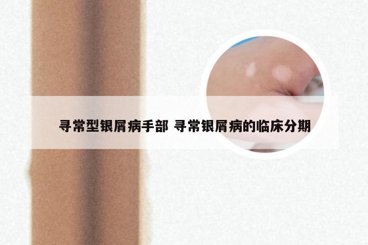 寻常型银屑病手部 寻常银屑病的临床分期