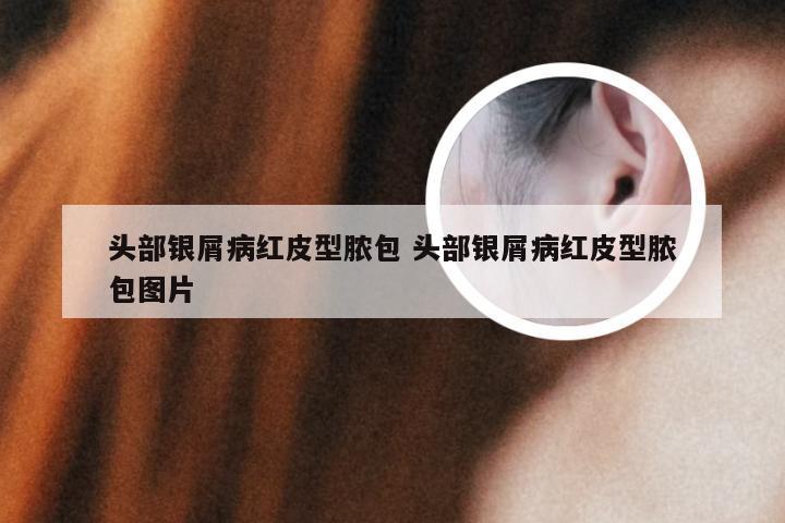 头部银屑病红皮型脓包 头部银屑病红皮型脓包图片