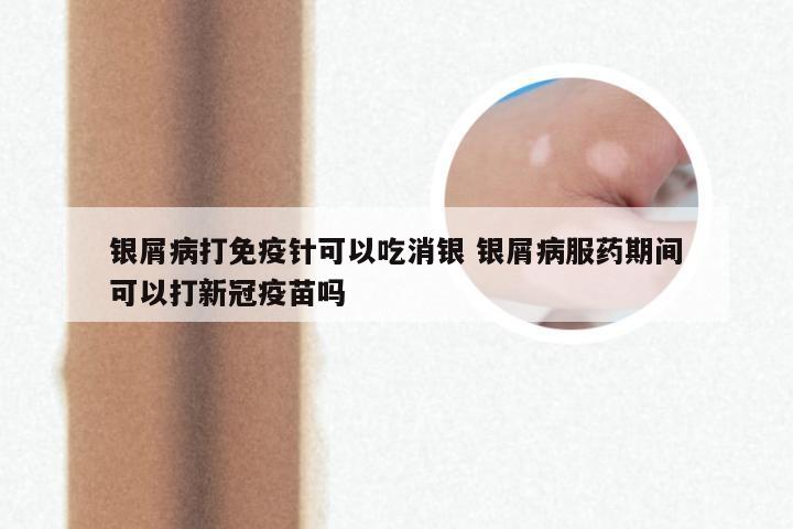 银屑病打免疫针可以吃消银 银屑病服药期间可以打新冠疫苗吗