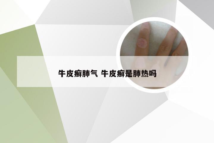 牛皮癣肺气 牛皮癣是肺热吗