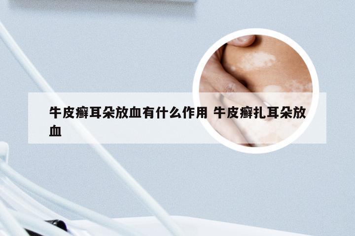 牛皮癣耳朵放血有什么作用 牛皮癣扎耳朵放血
