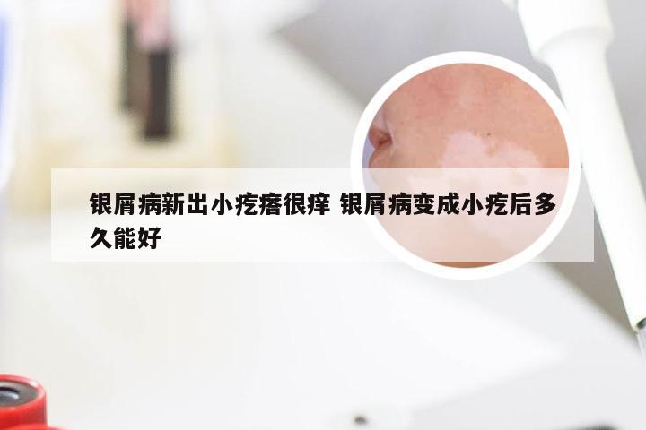 银屑病新出小疙瘩很痒 银屑病变成小疙后多久能好
