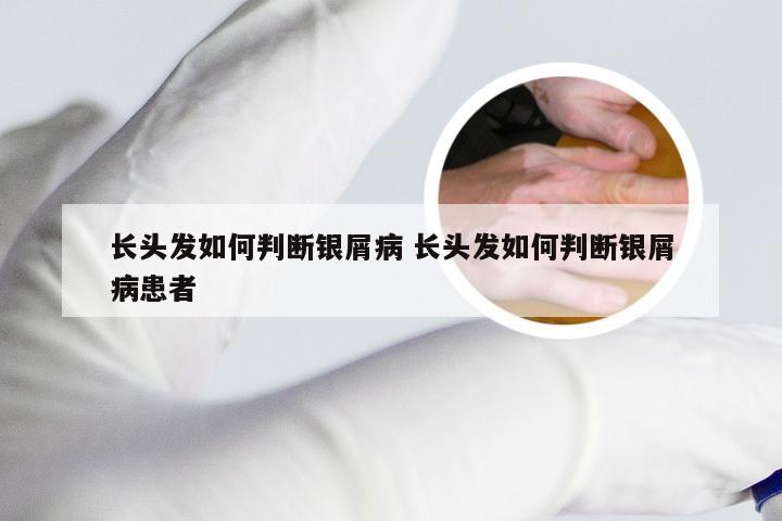 长头发如何判断银屑病 长头发如何判断银屑病患者