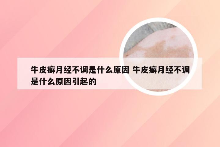 牛皮癣月经不调是什么原因 牛皮癣月经不调是什么原因引起的