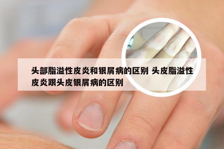 头部脂溢性皮炎和银屑病的区别 头皮脂溢性皮炎跟头皮银屑病的区别