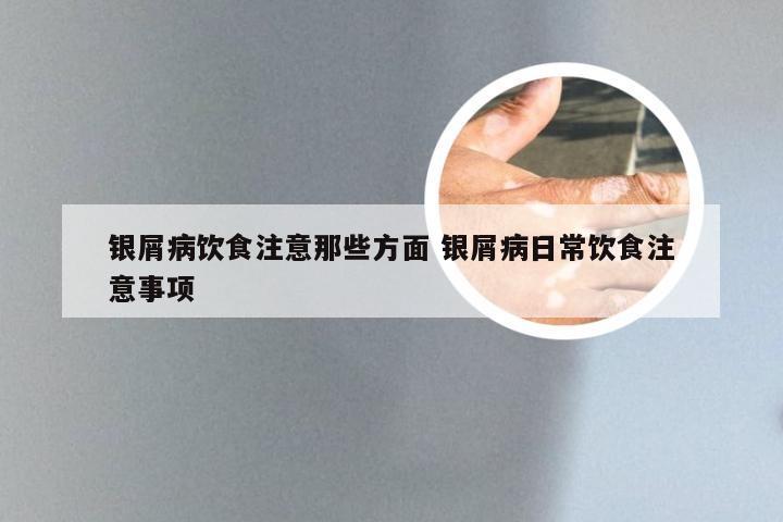 银屑病饮食注意那些方面 银屑病日常饮食注意事项