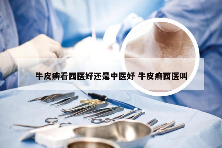 牛皮癣看西医好还是中医好 牛皮癣西医叫