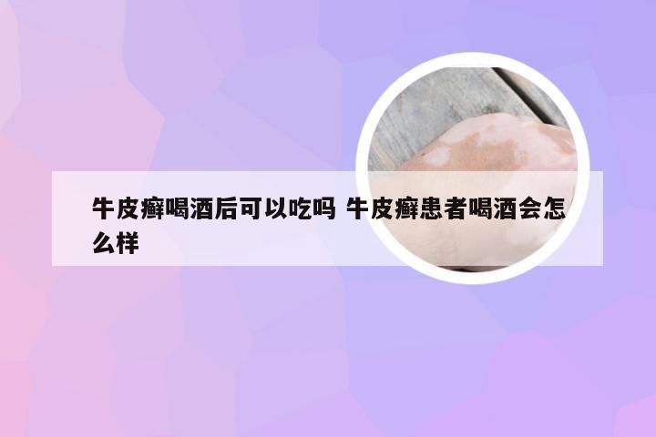 牛皮癣喝酒后可以吃吗 牛皮癣患者喝酒会怎么样