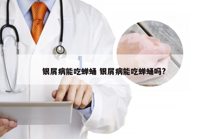 银屑病能吃蝉蛹 银屑病能吃蝉蛹吗?