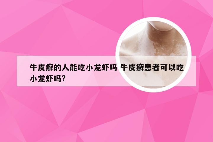 牛皮癣的人能吃小龙虾吗 牛皮癣患者可以吃小龙虾吗?