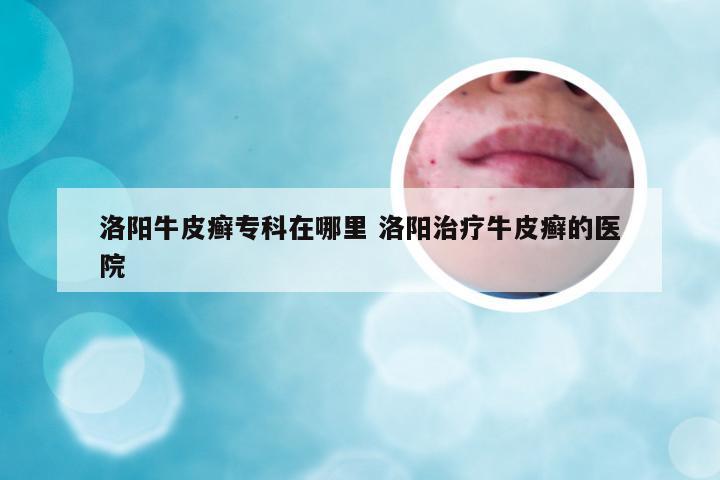 洛阳牛皮癣专科在哪里 洛阳治疗牛皮癣的医院