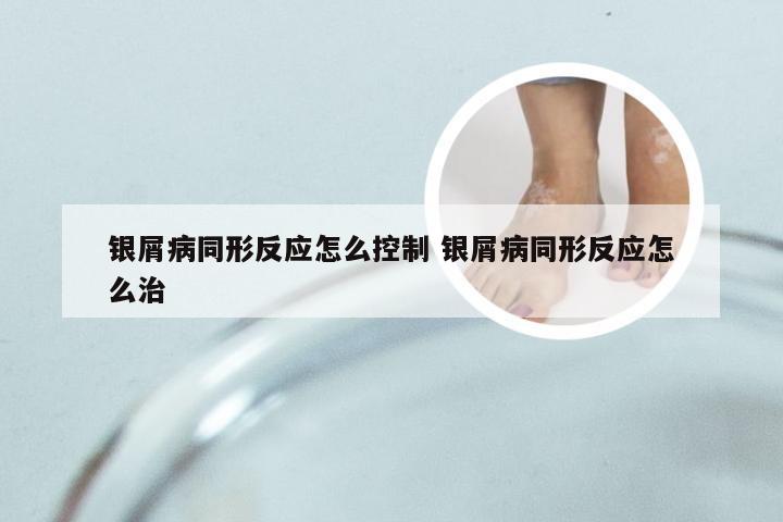 银屑病同形反应怎么控制 银屑病同形反应怎么治