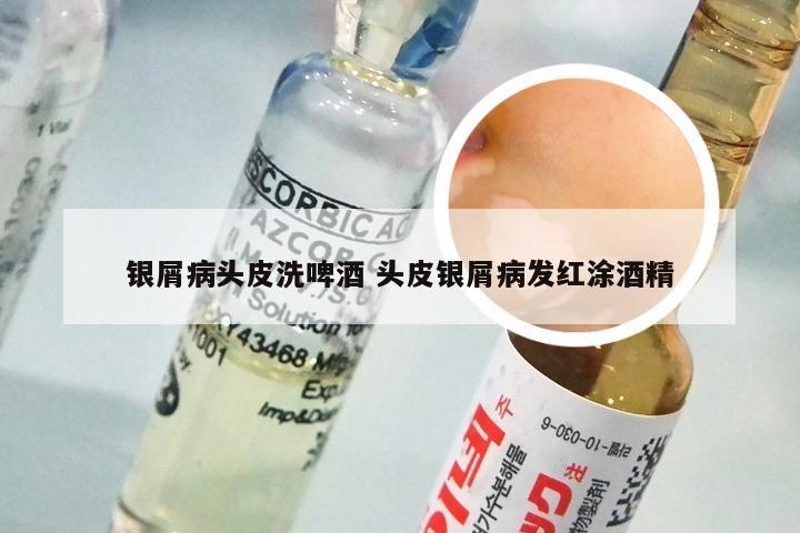 银屑病头皮洗啤酒 头皮银屑病发红涂酒精