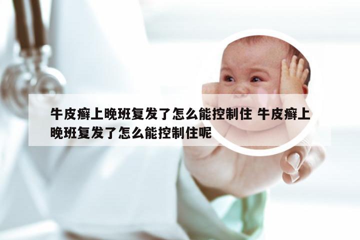 牛皮癣上晚班复发了怎么能控制住 牛皮癣上晚班复发了怎么能控制住呢