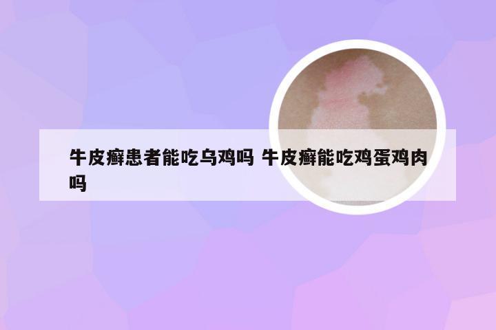 牛皮癣患者能吃乌鸡吗 牛皮癣能吃鸡蛋鸡肉吗